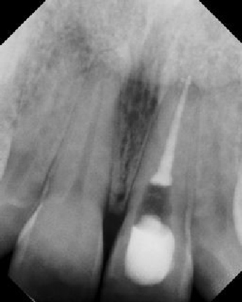 Root Canal with Calcified Canals - Stratford