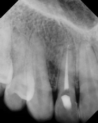 Root Canal with Calcified Canals - Stratford