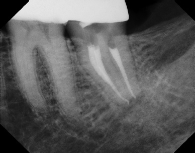 Root Canal - Access Through Crown