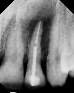 Apicoectomy - Surgical Root Canal