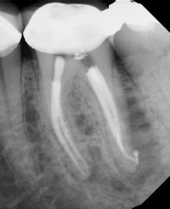 Root canal with large lesion - Meriden