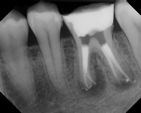 Root Canal Retreatment - Meriden