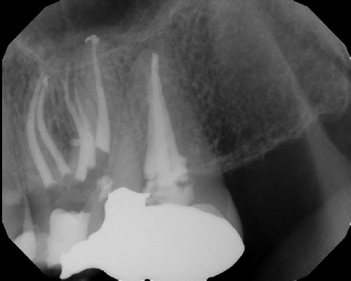 root canal anatomy - Meriden