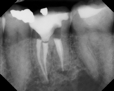 Root Canal - Broken Instrument Removal