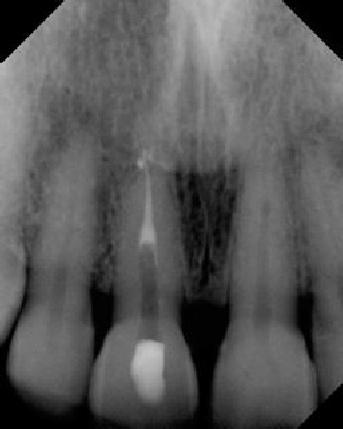 Root Canal with Calcified Canals - Stratford