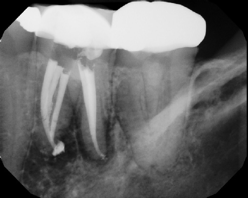 root canal anatomy - Meriden