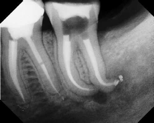 Root Canal Anatomy - Meriden