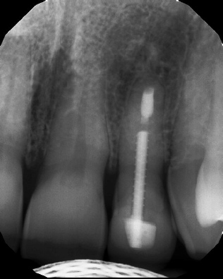 Apicoectomy - Surgical Root Canal