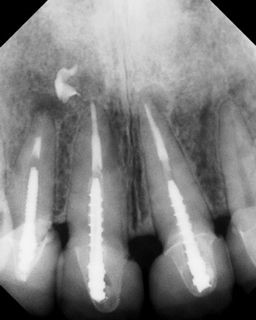 Apicoectomy - Surgical Root Canal