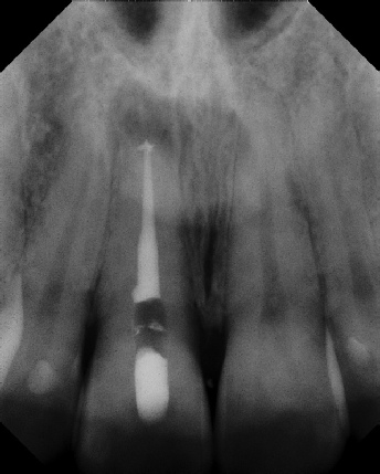 Root Canal with Calcified Canals - Stratford