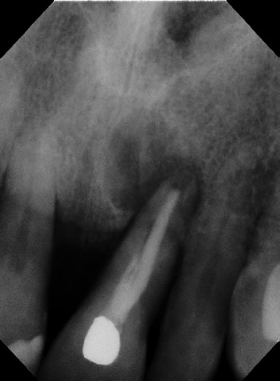 Root canal - Apexification