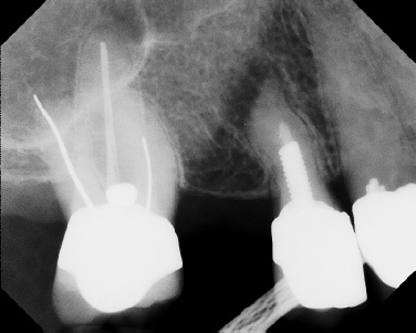 Apicoectomy - Surgical Root Canal