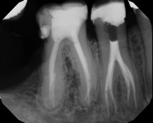 Root Canal Anatomy - Meriden