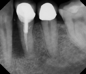 Root canal with large lesion - Stratford