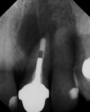 Apicoectomy - Surgical Root Canal