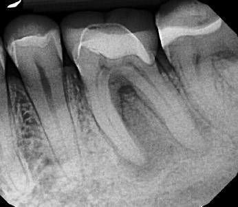 Root canal with large lesion - Stratford