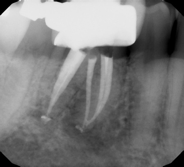 Root Canal Retreatment - Stratford