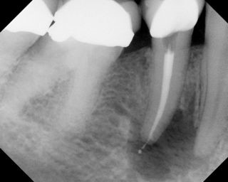 Apicoectomy - Surgical Root Canal