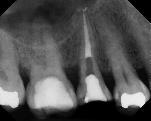 Root Canal - Broken Instrument Removal