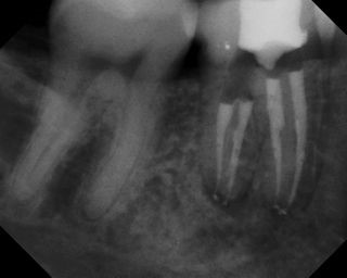 Root Canal - Broken Instrument Removal