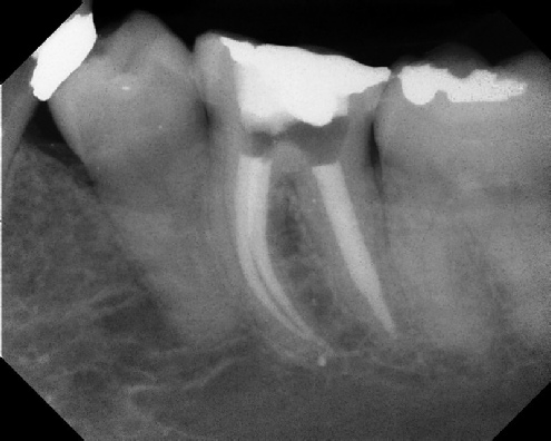 Root Canal Retreatment - Stratford