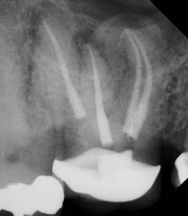 Root Canal - Access Through Crown