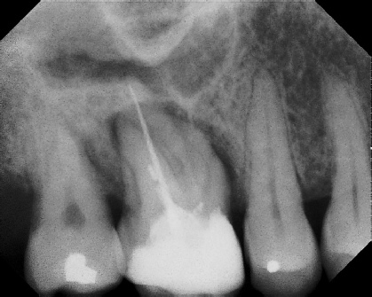 Root Canal - Broken Instrument Removal