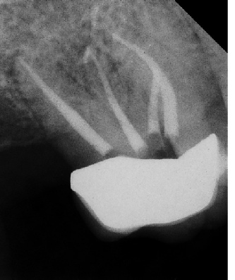 Root Canal - Access Through Crown