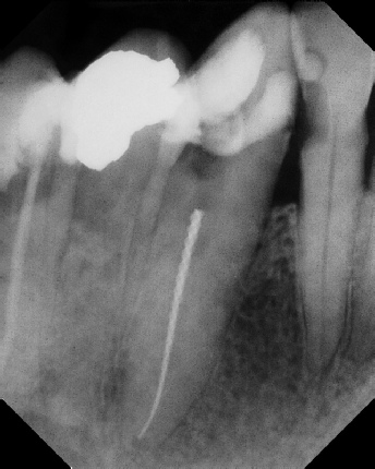 Root Canal - Broken Instrument Removal