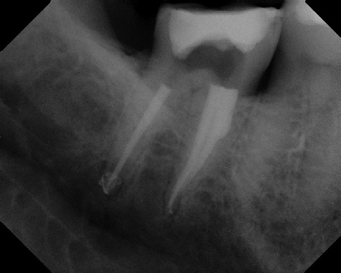 Root Canal - Broken Instrument Removal