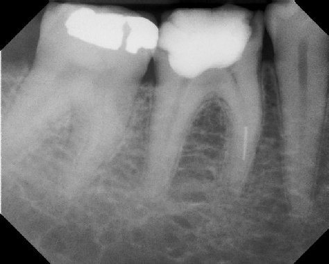 Root Canal - Broken Instrument Removal