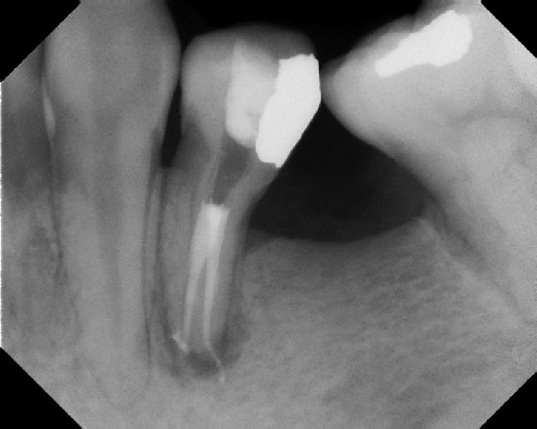 root canal anatomy - Stratford