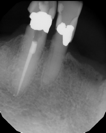 Root Canal with Calcified Canals - Meriden