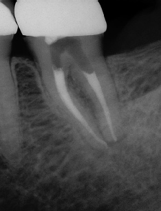 Root Canal - Access Through Crown