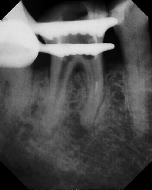 Root Canal - Broken Instrument Removal