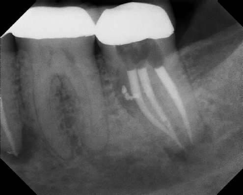 Root Canal Retreatment - Meriden