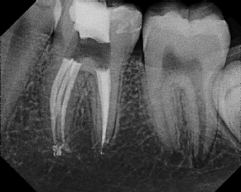 root canal anatomy - Meriden