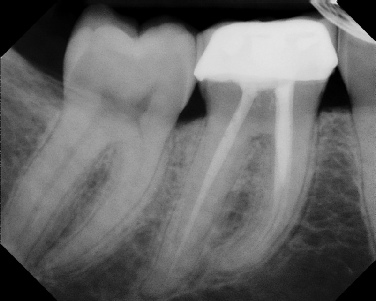 Root Canal Retreatment - Stratford