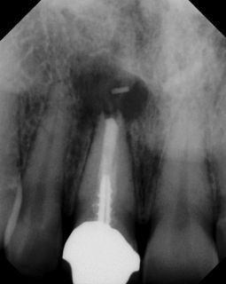 Apicoectomy - Surgical Root Canal