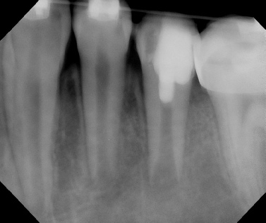 Root canal - Apexogenesis