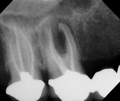 Root Canal Retreatment - Meriden