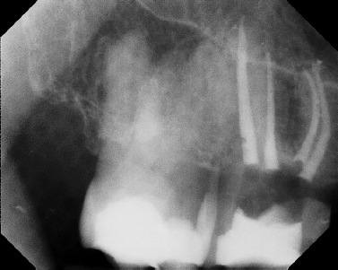 Root Canal - Broken Instrument Removal