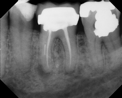 Root Canal - Broken Instrument Removal