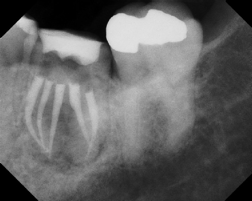 root canal anatomy - Meriden