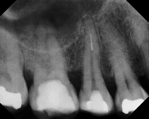 Root Canal - Broken Instrument Removal