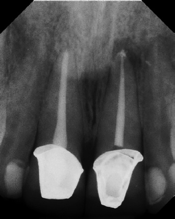 Root Canal with Calcified Canals - Meriden