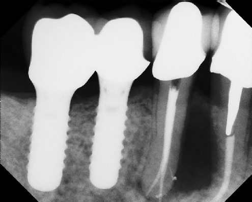 Root Canal - Access Through Crown