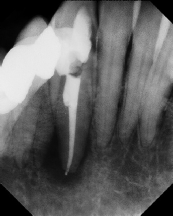 Root Canal - Broken Instrument Removal