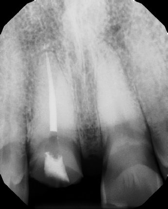 Root Canal with Calcified Canals - Meriden