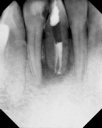 root canal anatomy - Stratford